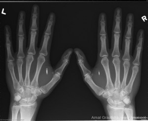 X-Ray image of chipped hands, by Amal Graafstra